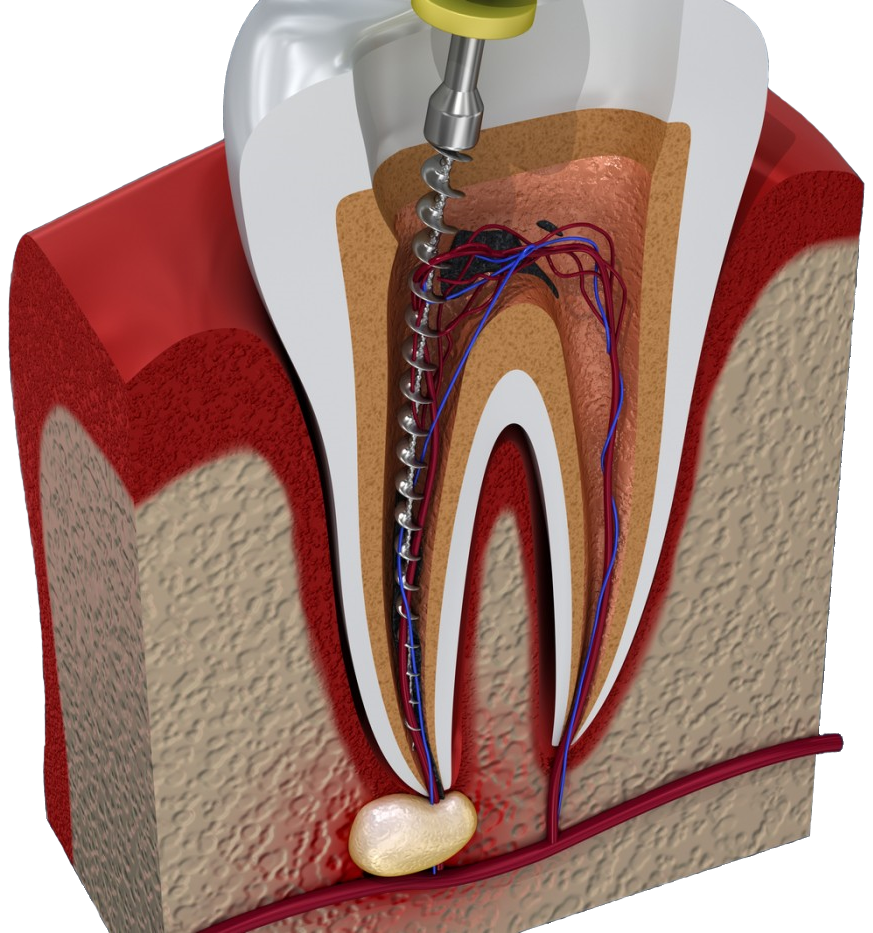 Обработка и пломбирование корневых каналов. Расширитель зубных каналов.